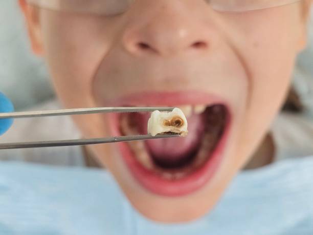 Best Urgent Dental Care for Toothaches in Angels, CA